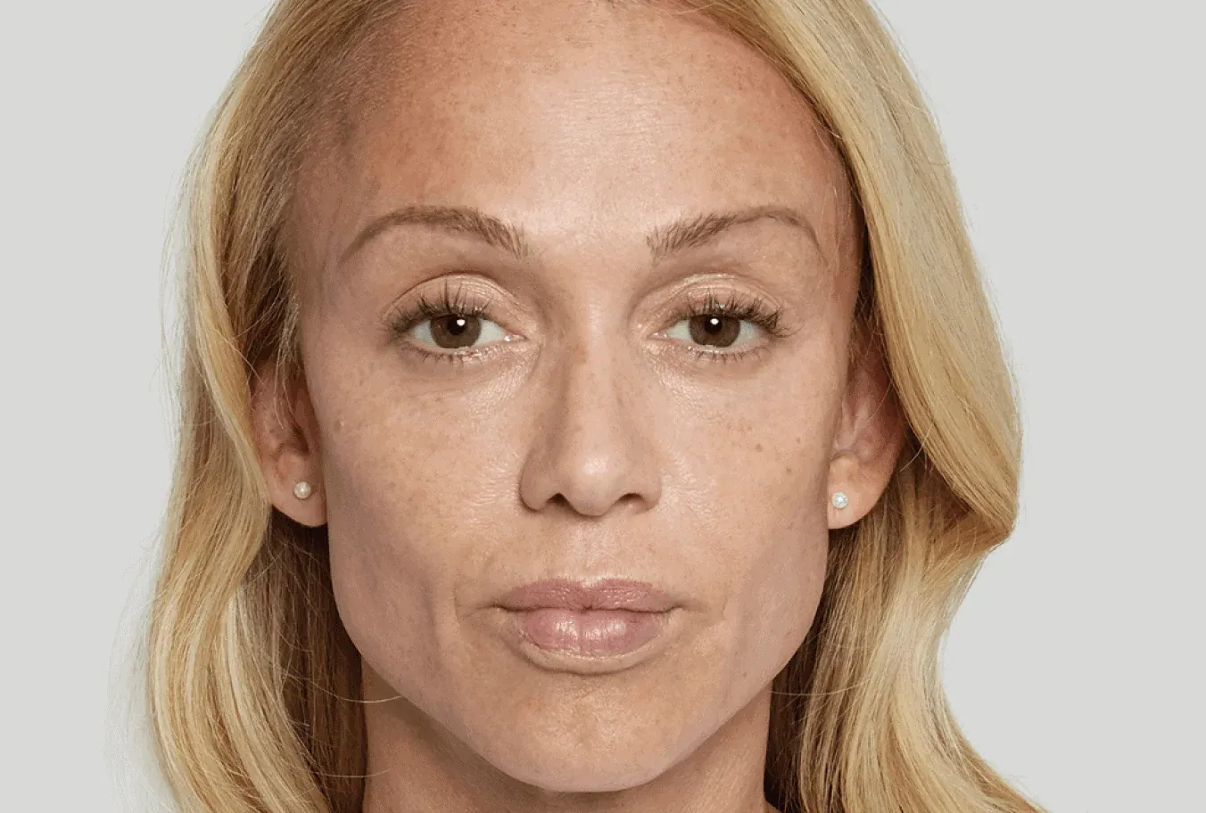 Anna, age 43, after Sculptra treatment