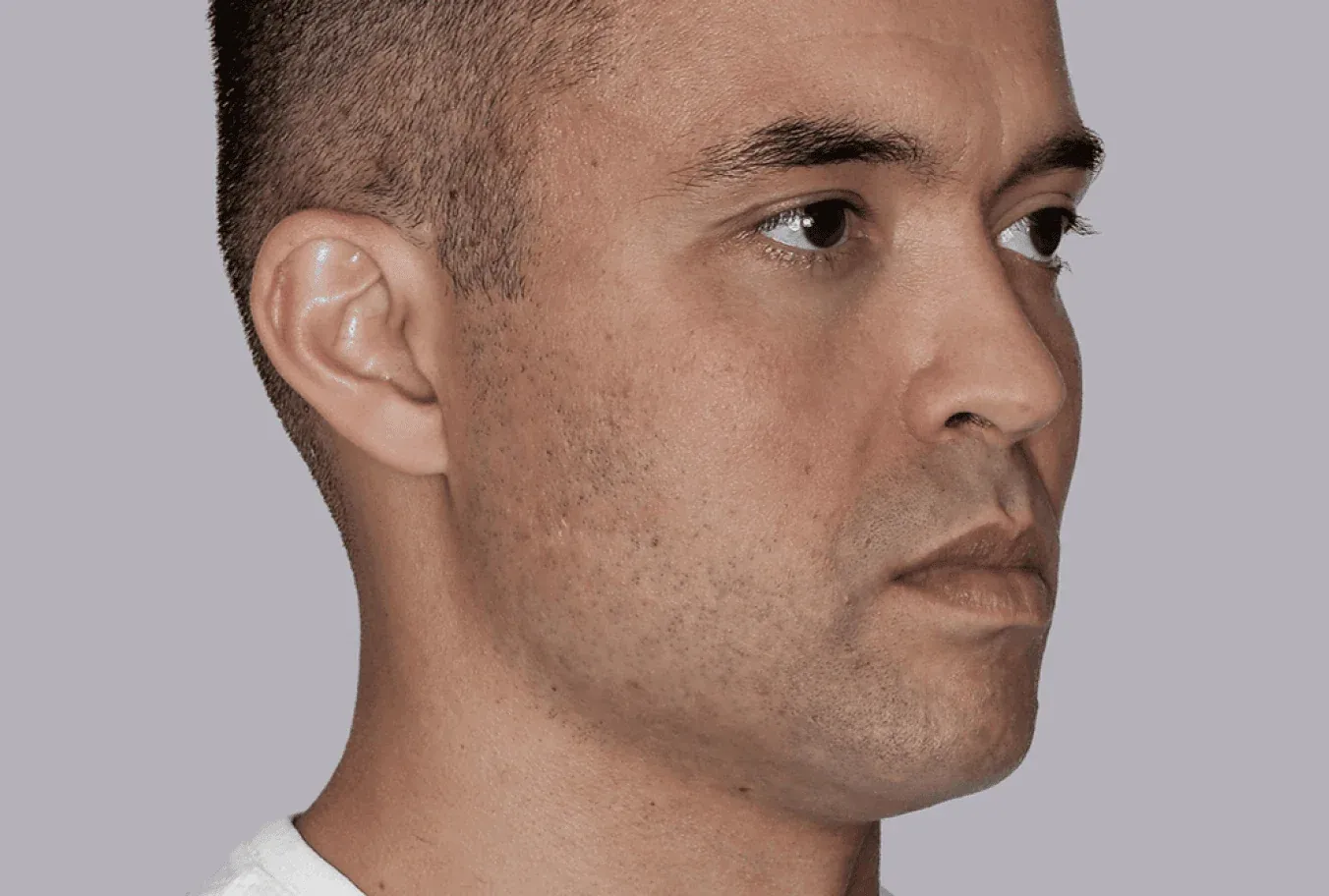 Farney, age 33, after Sculptra treatment