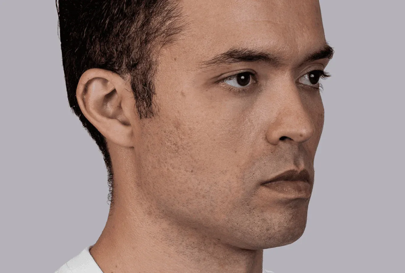 Farney, age 33, prior to Sculptra treatment
