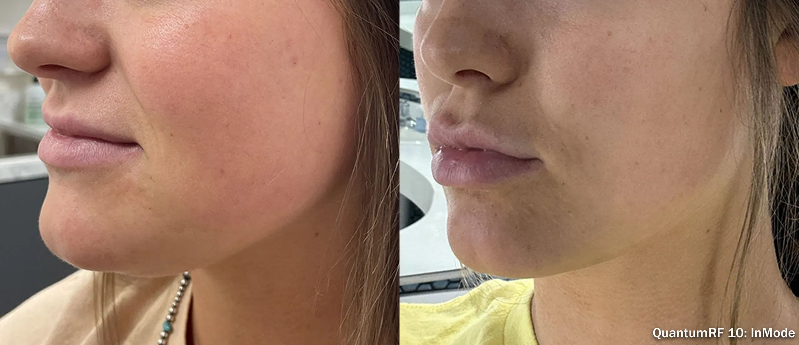 QuantumRF jawline contouring result