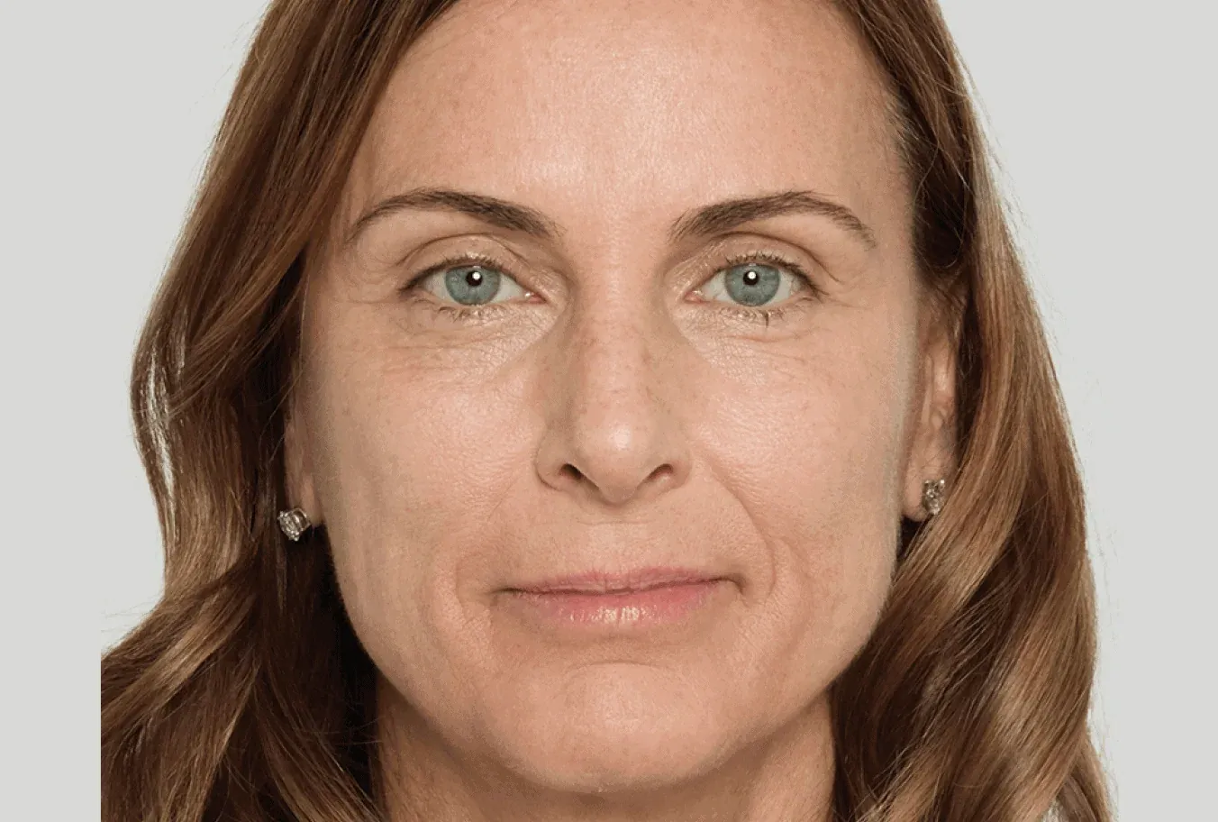 Katherine, age 53, after Sculptra treatment