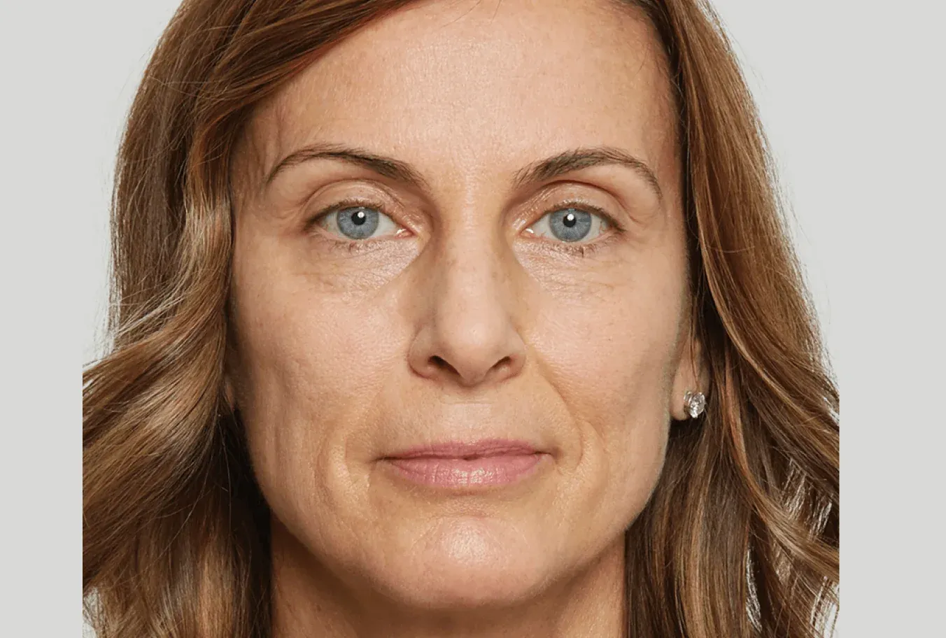 Katherine, age 53, prior to Sculptra treatment