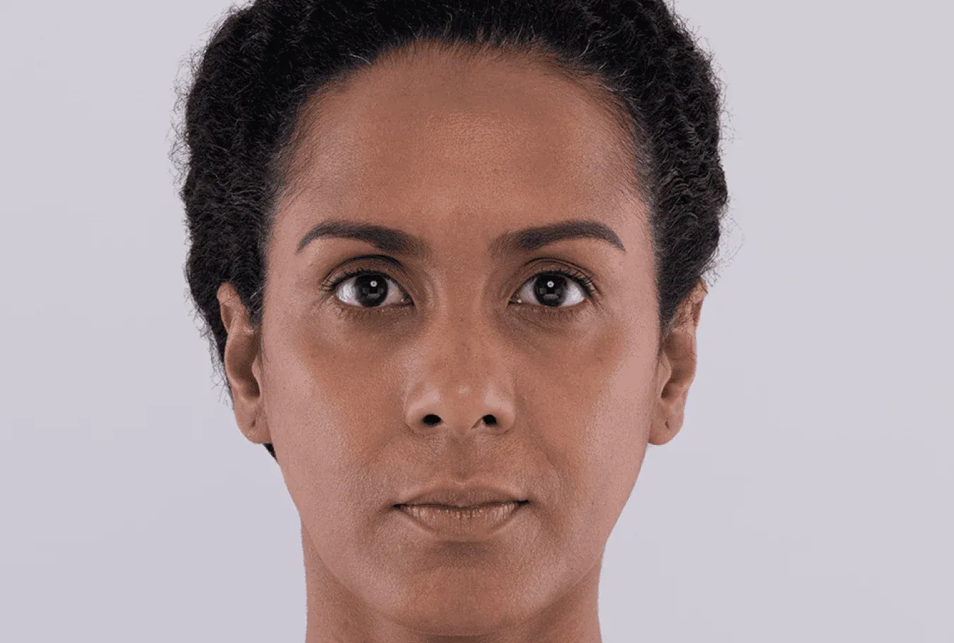 Maidelys, age 38, after Sculptra treatment