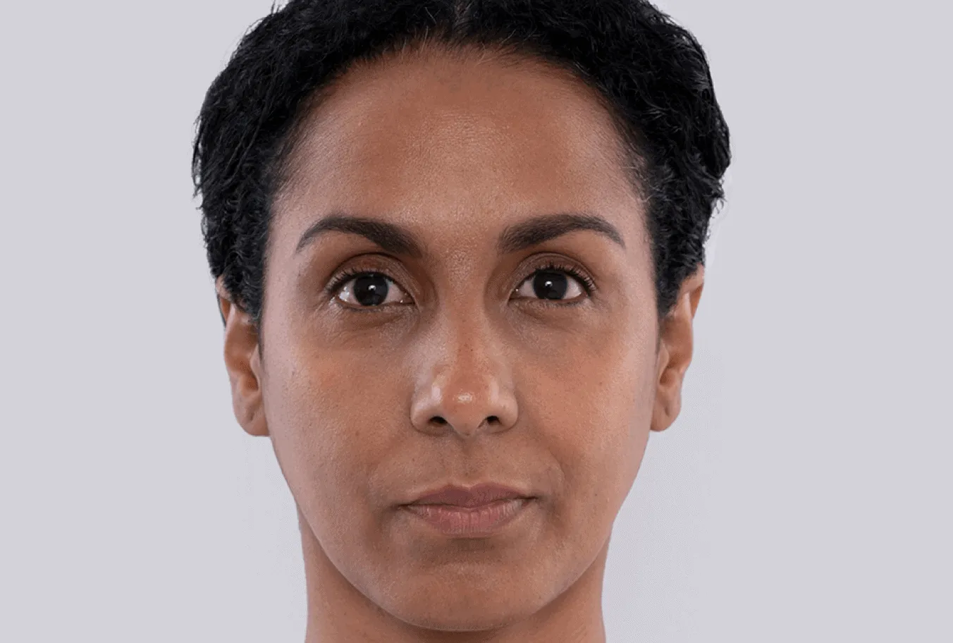 Maidelys, age 38, prior to Sculptra treatment