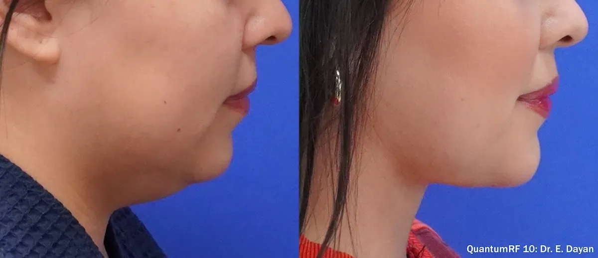 QuantumRF internal radiofrequency contouring at Aetheria Aesthetics & Wellness
