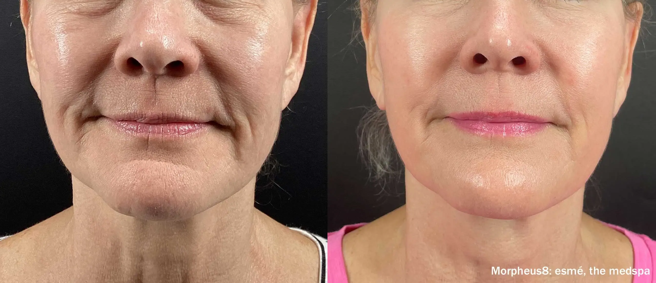 Morpheus8 full face before and after
