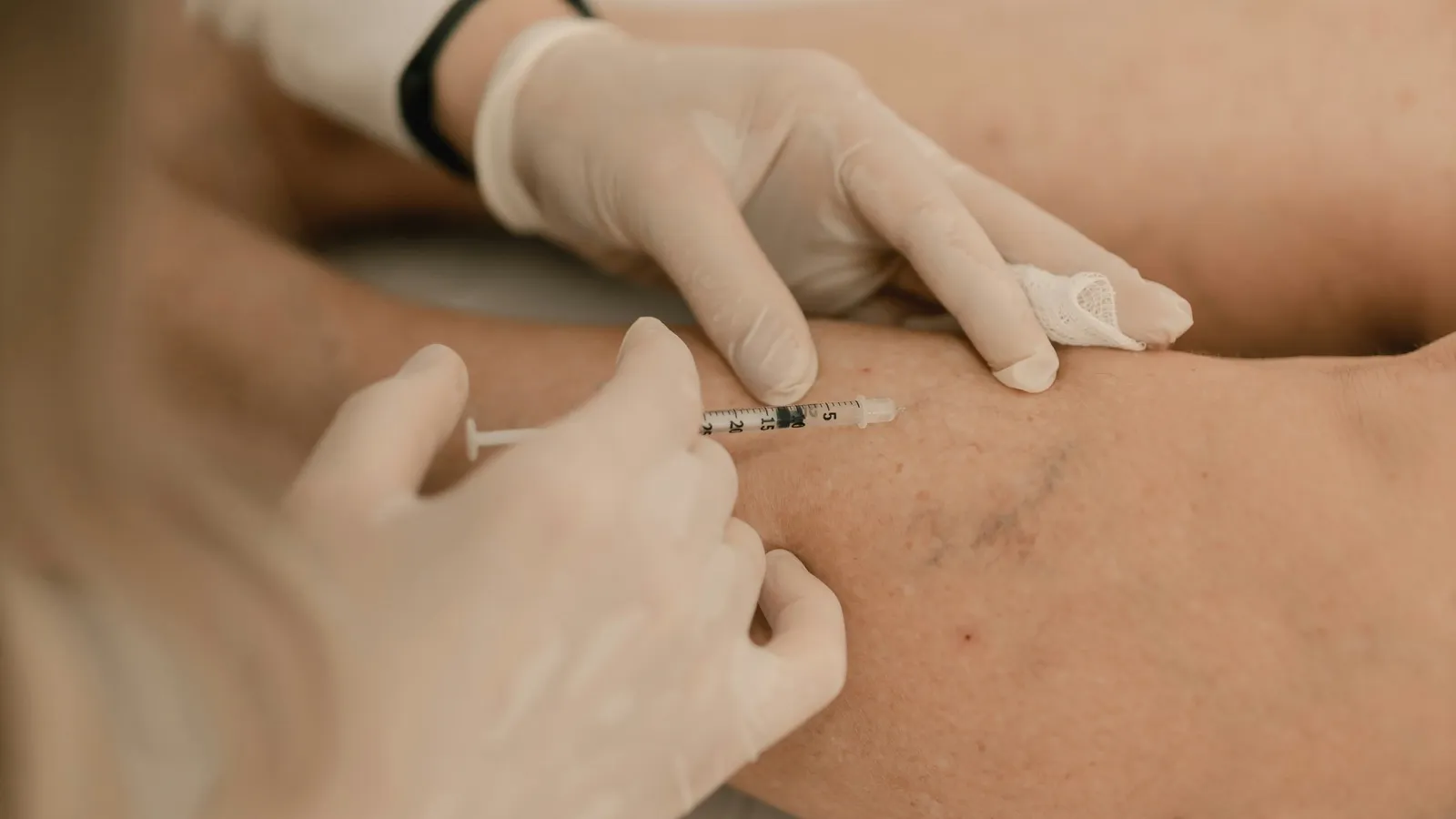 Provider injecting sclerotherapy solution into spider veins on a leg