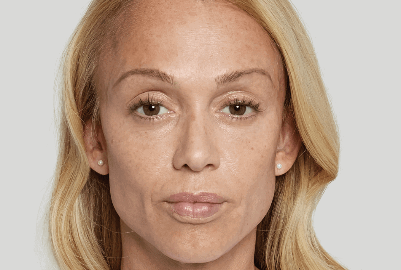 Anna, age 43, 6 months after Sculptra treatment