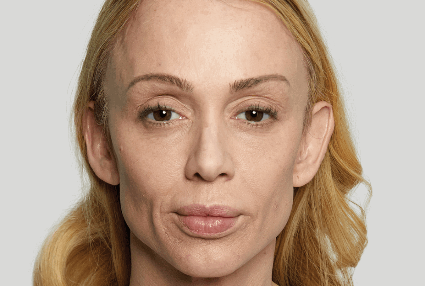 Anna, age 43, before Sculptra treatment