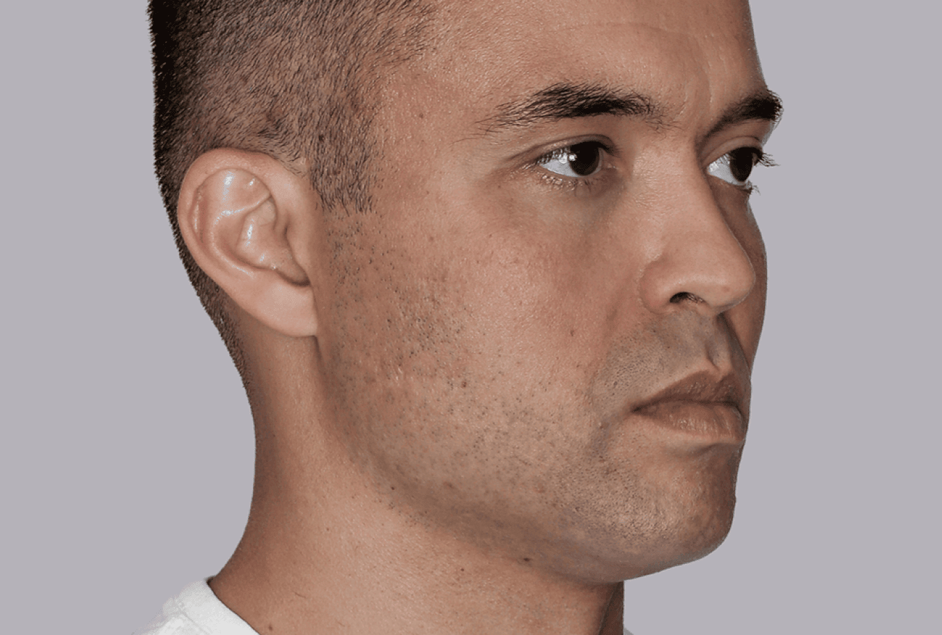 Farney, age 33, 6 months after Sculptra treatment