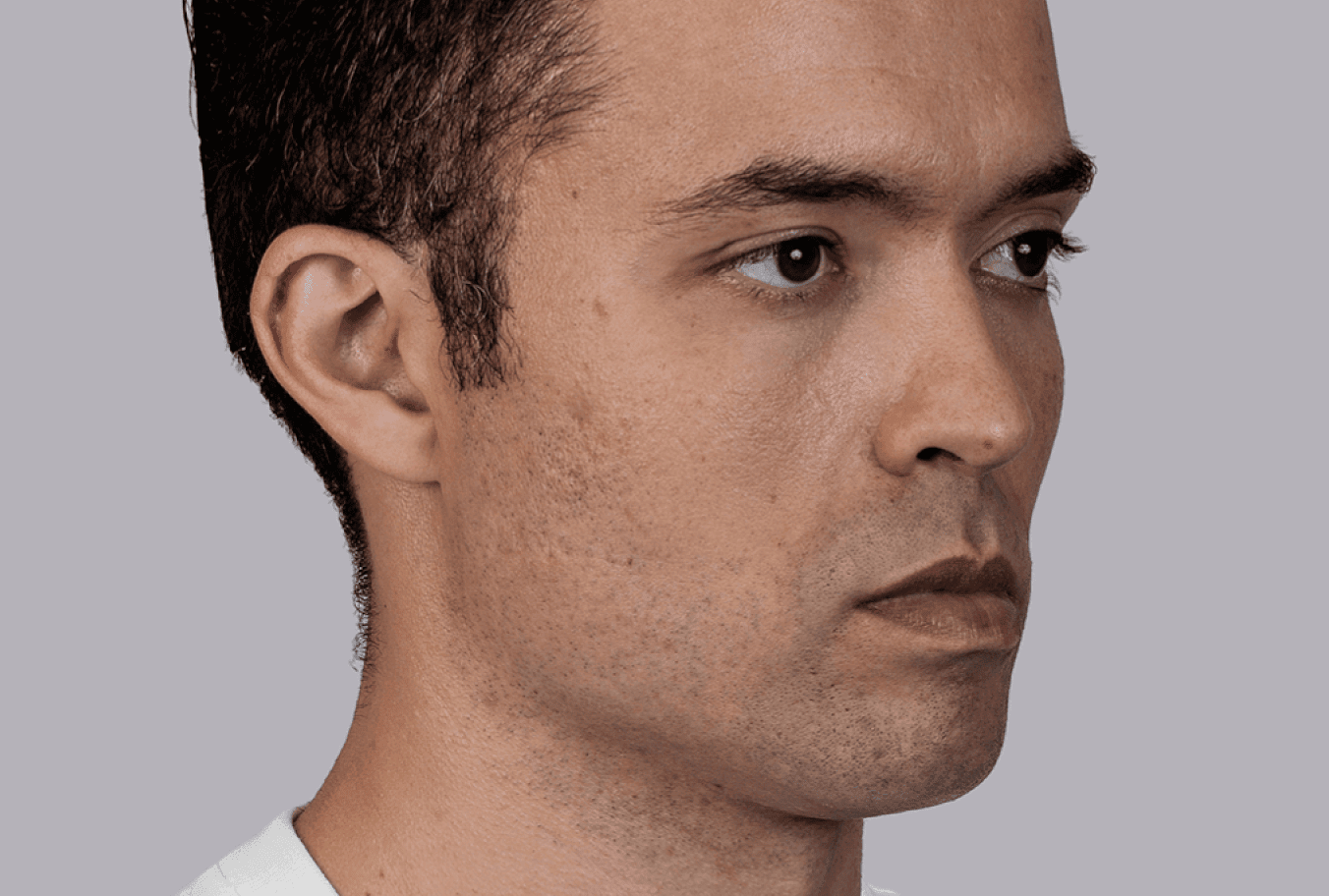 Farney, age 33, before Sculptra treatment