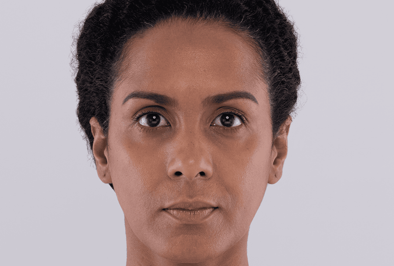 Maidelys, age 38, 9 months after Sculptra treatment
