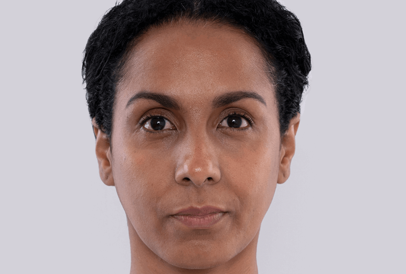 Maidelys, age 38, before Sculptra treatment