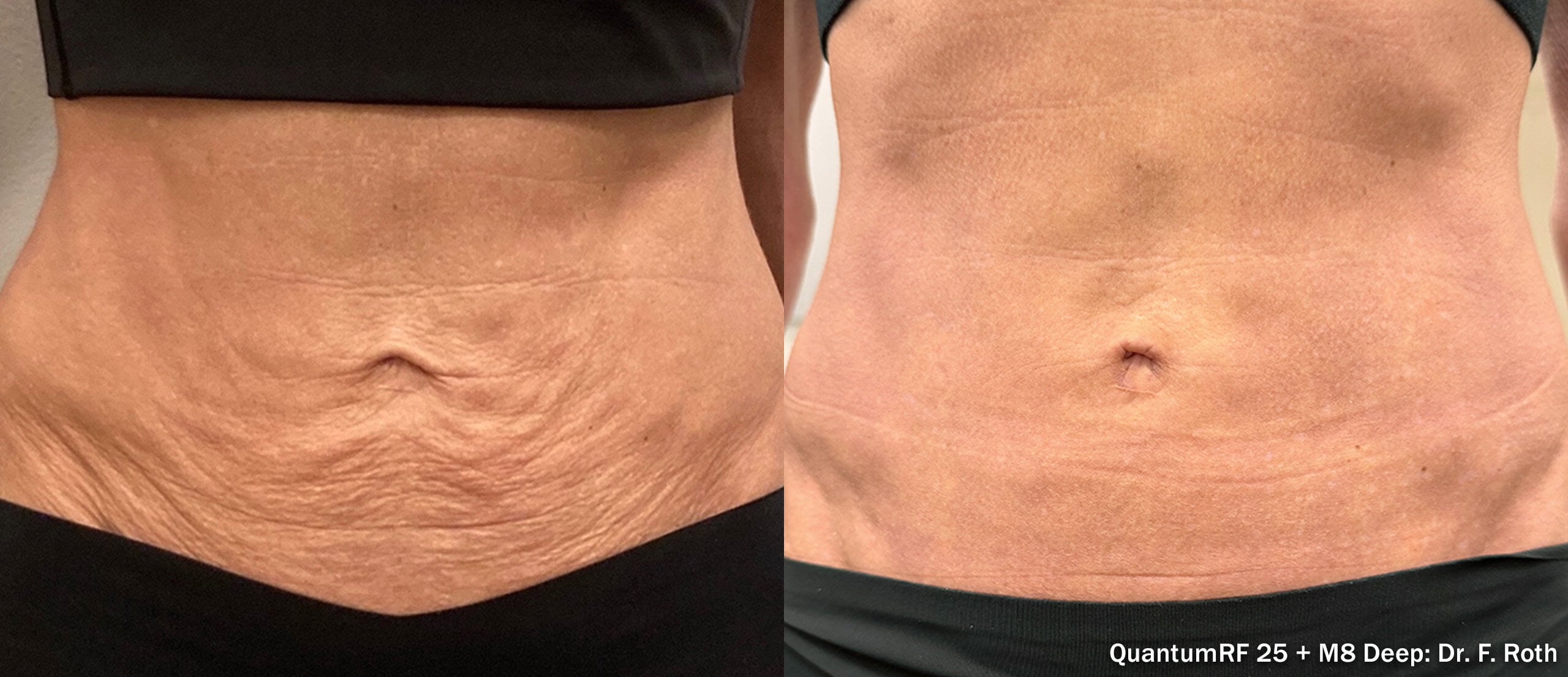 Morpheus8 RF microneedling result at Aetheria Aesthetics & Wellness&trade;