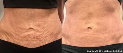 Morpheus8 RF microneedling result at Aetheria Aesthetics & Wellness, Pittsburgh