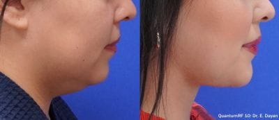 QuantumRF internal RF contouring result at Aetheria Aesthetics & Wellness, Pittsburgh